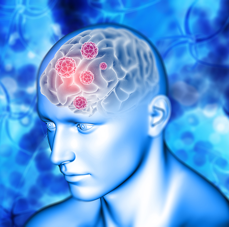 3D medical background with brain highlighted Brain neurofibromatosis